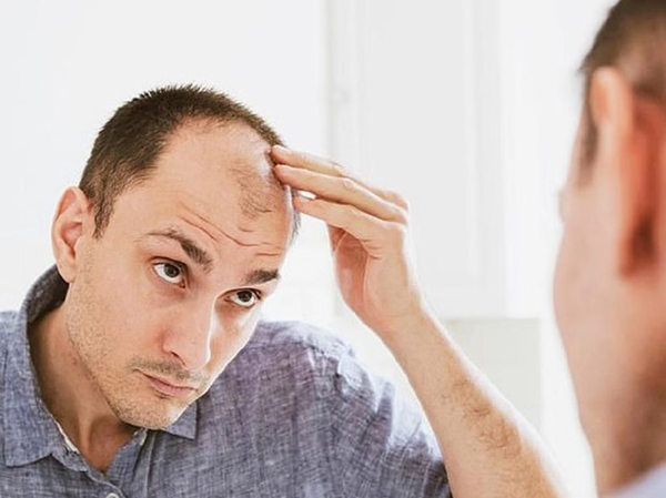 Rụng tóc do hút thuốc lá có phục hồi được không?