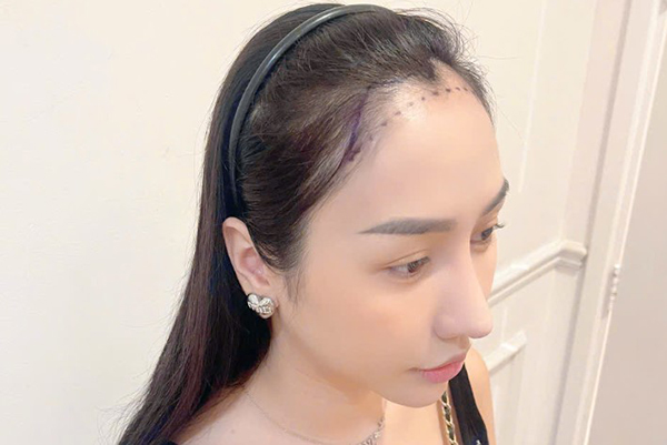 Trán bò liếm có cấy tóc được không?