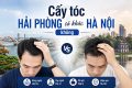 Cấy tóc Hải Phòng có khác Hà Nội không