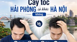 Cấy tóc Hải Phòng có khác Hà Nội không? So sánh trước khi lựa chọn