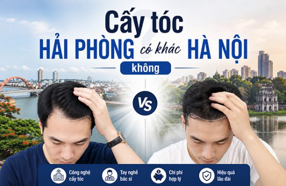 Cấy tóc Hải Phòng có khác Hà Nội không