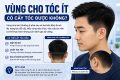 Vùng cho tóc ít có cấy tóc được không?