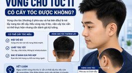 Vùng cho tóc ít có cấy tóc được không? Những điều cần biết trước khi cấy