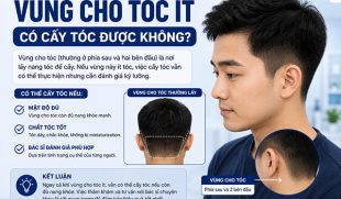 Vùng cho tóc ít có cấy tóc được không? Những điều cần biết trước khi cấy
