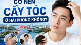 Có nên cấy tóc ở Hải Phòng không? 4 Lý do không thể bỏ qua