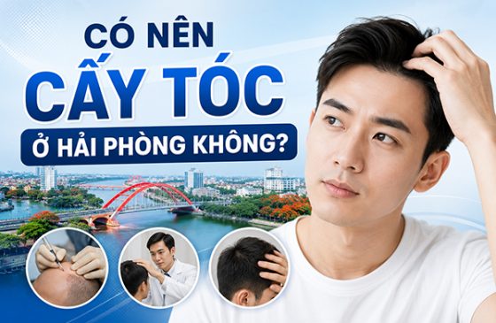 Có nên cấy tóc ở Hải Phòng không? 4 Lý do không thể bỏ qua