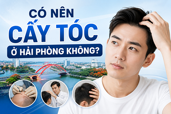 Có nên cấy tóc ở Hải Phòng không? 4 Lý do không thể bỏ qua