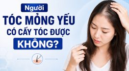Bác sĩ giải đáp: Người tóc mỏng yếu có cấy tóc được không?