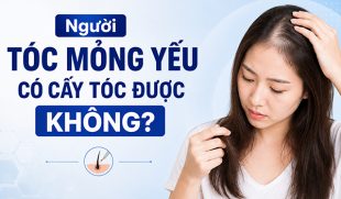 Bác sĩ giải đáp: Người tóc mỏng yếu có cấy tóc được không?