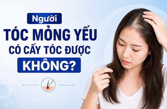 Người tóc mỏng yếu có cấy tóc được không?
