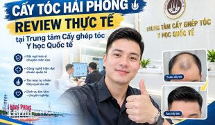 Cấy tóc Hải Phòng review thực tế tại Trung tâm Cấy ghép tóc Y học Quốc tế