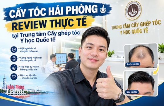 Cấy tóc Hải Phòng review thực tế tại Trung tâm Cấy ghép tóc Y học Quốc tế