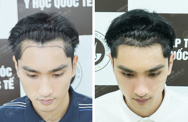 hình ảnh trước và sau khi cấy của người mẫu Huy Quang