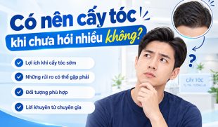 [Giải đáp]: Có nên cấy tóc khi chưa hói nhiều không?