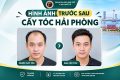 Hình ảnh trước sau cấy tóc Hải Phòng