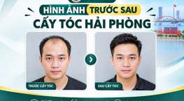 Hình ảnh trước sau cấy tóc Hải Phòng: Kết quả thực tế ra sao?