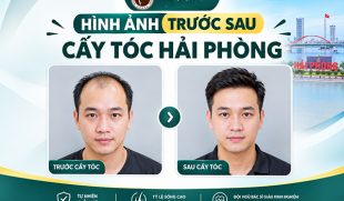 Hình ảnh trước sau cấy tóc Hải Phòng: Kết quả thực tế ra sao?