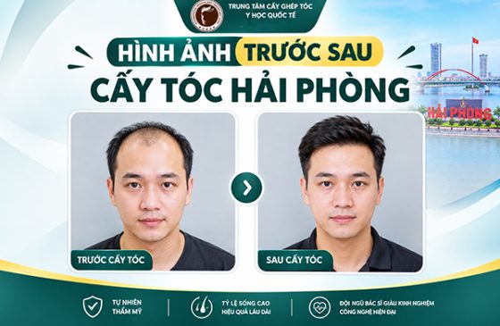 Hình ảnh trước sau cấy tóc Hải Phòng