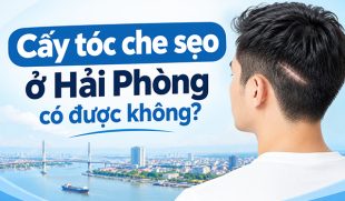 Cấy tóc che sẹo ở Hải Phòng có được không? Quy trình, chi phí và lưu ý