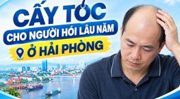 Cấy tóc cho người hói lâu năm ở Hải Phòng có được không?