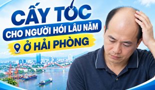 Cấy tóc cho người hói lâu năm ở Hải Phòng có được không?