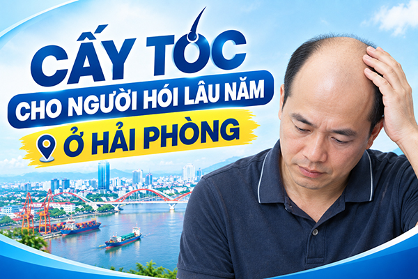 Cấy tóc cho người hói lâu năm ở Hải Phòng có được không?