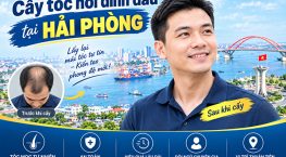Cấy tóc hói đỉnh đầu tại Hải Phòng: 8 Thông tin cần biết trước khi thực hiện