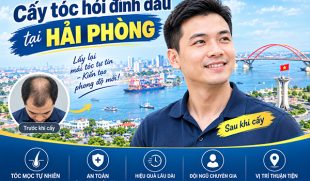 Cấy tóc hói đỉnh đầu tại Hải Phòng: 8 Thông tin cần biết trước khi thực hiện