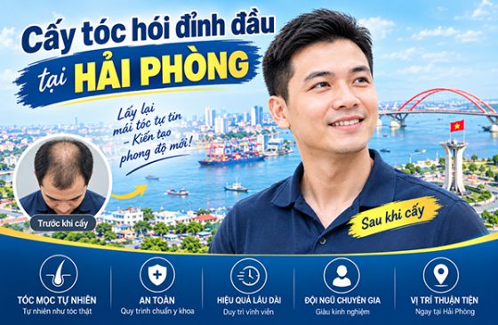 Cấy tóc hói đỉnh đầu tại Hải Phòng