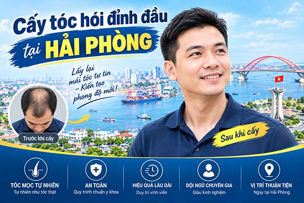 Cấy tóc hói đỉnh đầu tại Hải Phòng