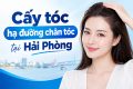 cấy tóc hạ đường chân tóc tại Hải Phòng