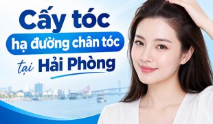 [Tìm Hiểu] : Cấy tóc hạ đường chân tóc tại Hải Phòng