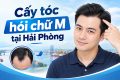Cấy tóc hói chữ M tại Hải Phòng