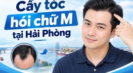 Cấy tóc hói chữ M tại Hải Phòng: Phương pháp, chi phí, địa chỉ