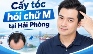 Cấy tóc hói chữ M tại Hải Phòng: Phương pháp, chi phí, địa chỉ
