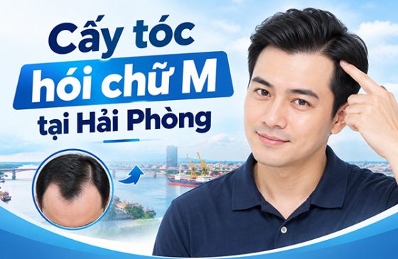 Cấy tóc hói chữ M tại Hải Phòng