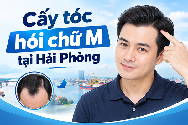 Cấy tóc hói chữ M tại Hải Phòng