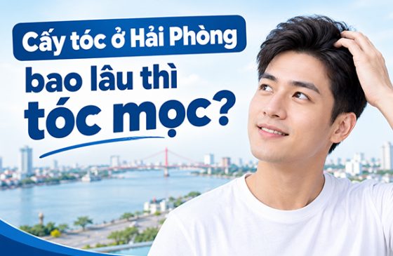 Cấy tóc ở Hải Phòng bao lâu thì tóc mọc?