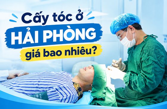 Cấy tóc ở Hải Phòng bao nhiêu tiền?
