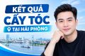 Kết quả cấy tóc tại Hải Phòng thực tế sau 1 năm