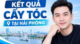 Kết quả cấy tóc tại Hải Phòng thực tế sau 1 năm