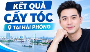 Kết quả cấy tóc tại Hải Phòng thực tế sau 1 năm