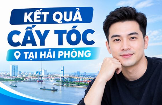 Kết quả cấy tóc tại Hải Phòng thực tế sau 1 năm