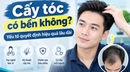 Cấy tóc có bền không? Yếu tố quyết định hiệu quả lâu dài