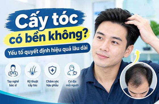 Cấy tóc có bền không? Yếu tố quyết định hiệu quả lâu dài