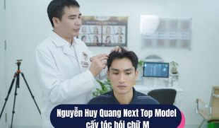 Nguyễn Huy Quang Next Top Model cấy tóc hói chữ M