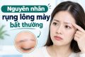 7 Nguyên nhân rụng lông mày bất thường bạn không nên bỏ qua