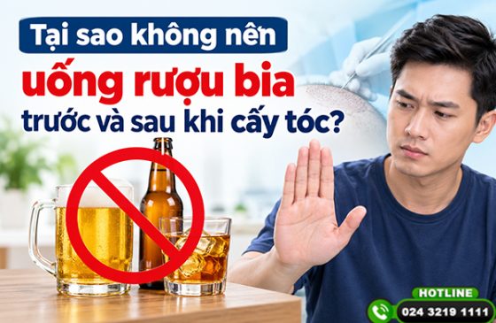 Tại sao không nên uống rượu bia trước và sau khi cấy tóc?