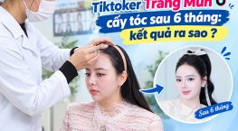 Trang Mun cấy tóc sau 6 tháng: Kết quả thay đổi đường chân tóc ra sao?