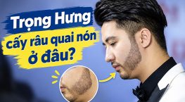 Trọng Hưng cấy râu quai nón ở đâu? Sự thật về phương pháp cấy râu tự thân
